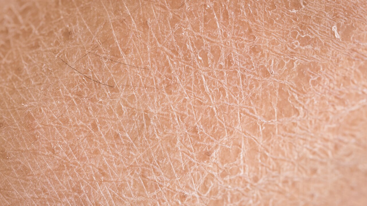 Dry skin