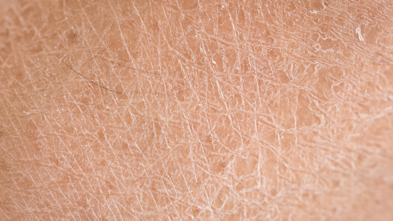 Dry skin
