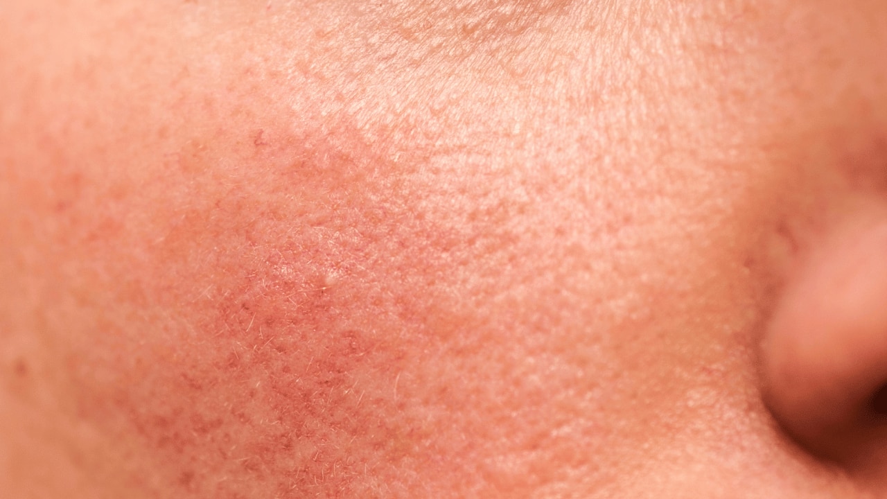 Sensitive skin