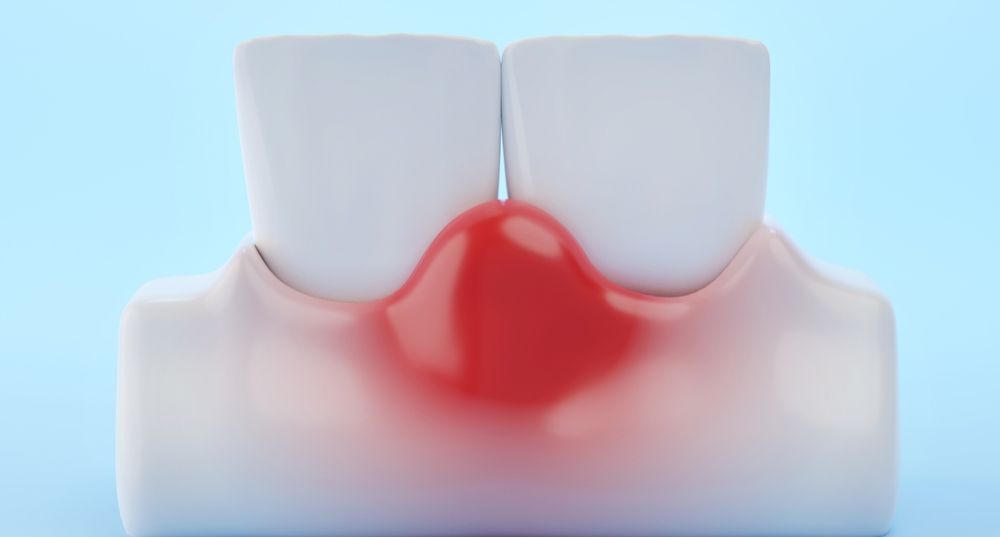 makanan untuk gusi bengkak