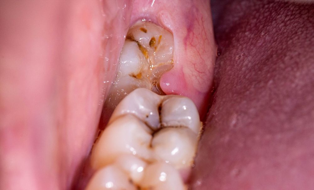 gigi bungsu berlubang