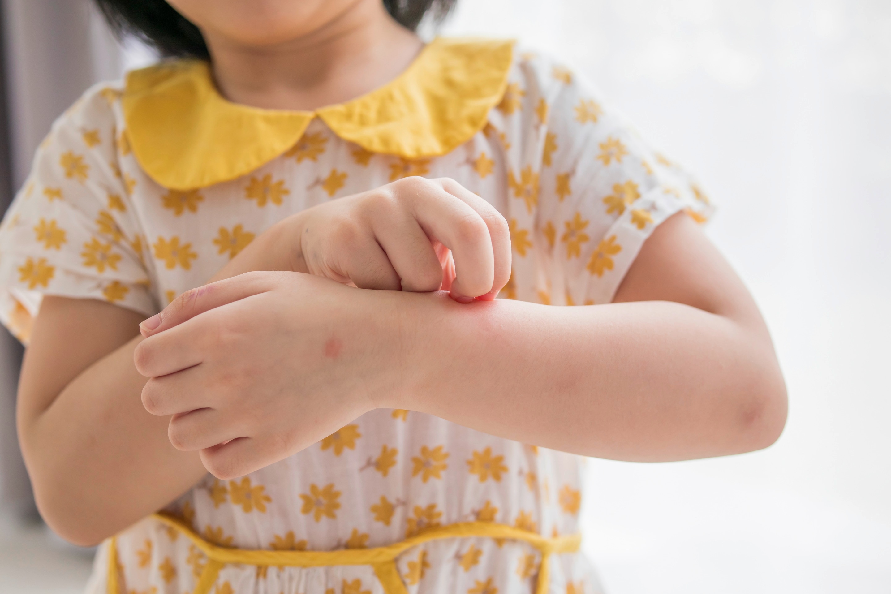anak kecil dengan dress kuning sedang menggaruk lengannya yang memerah akibat alergi