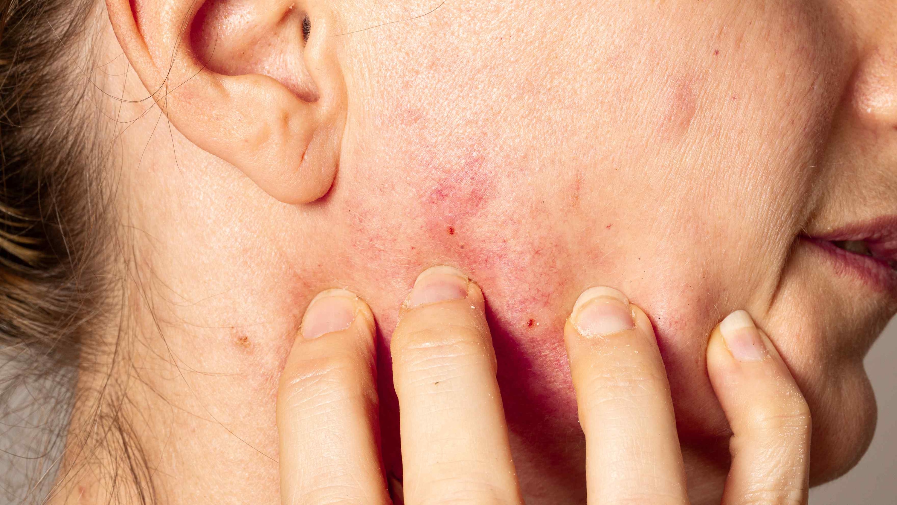 Possible Side Effects (Rare) -