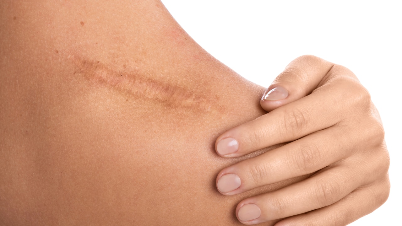 Wound Healing