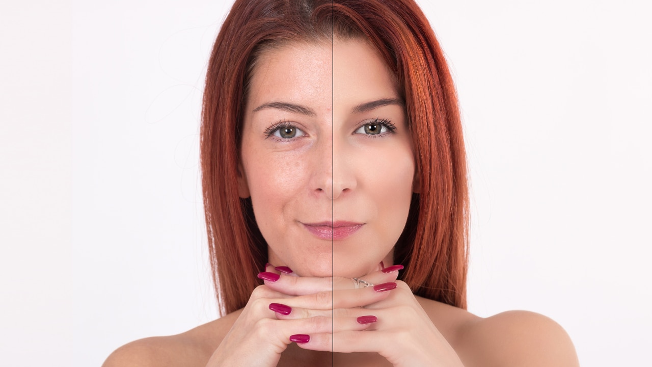 Microneedling Before and After: What to Expect