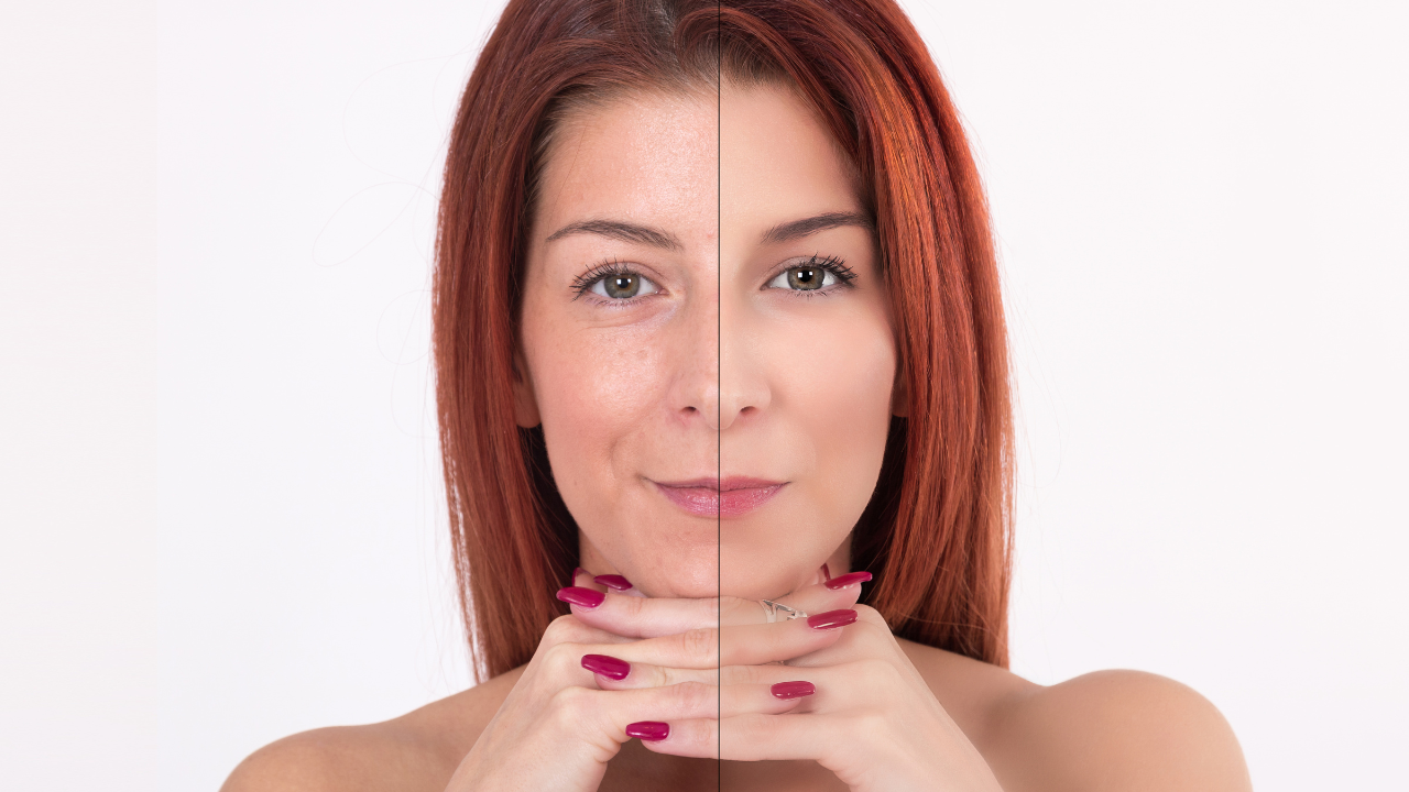 Microneedling Before and After: What to Expect