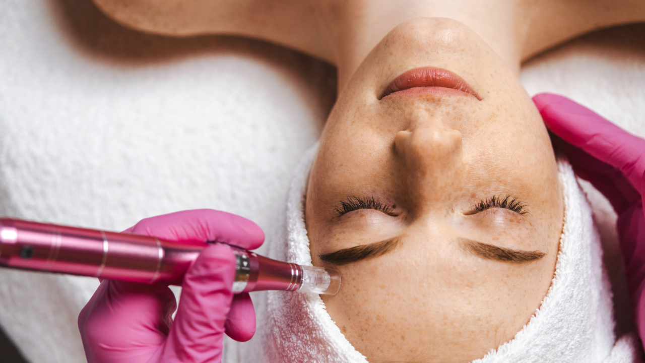 Microneedling Benefits for Skin
