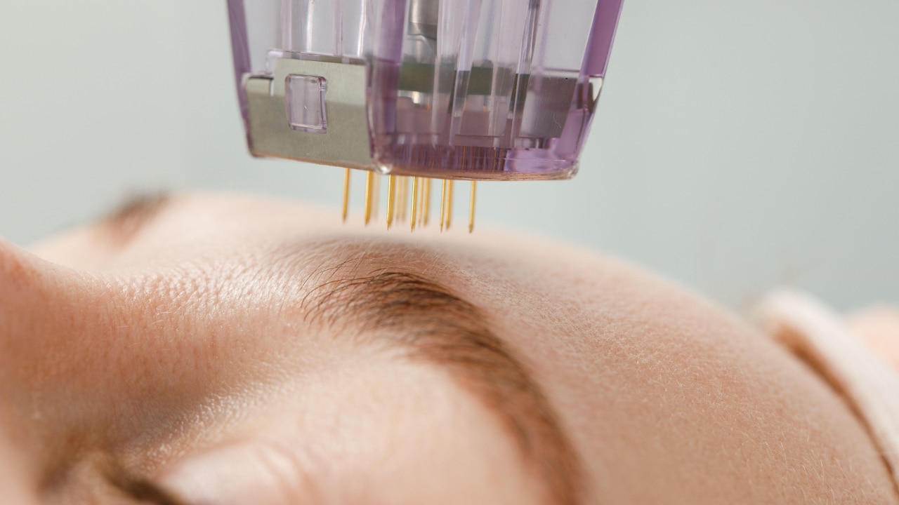 Microneedling for Acne Scars