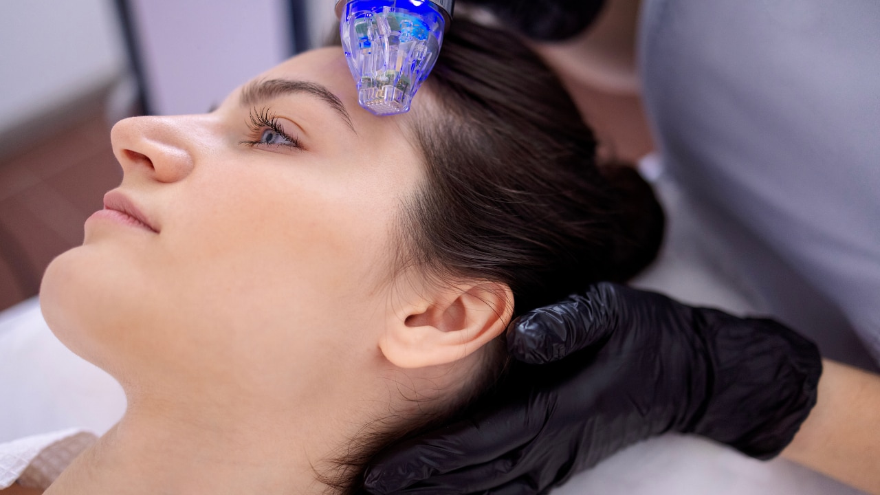 Microneedling for Pigmentation