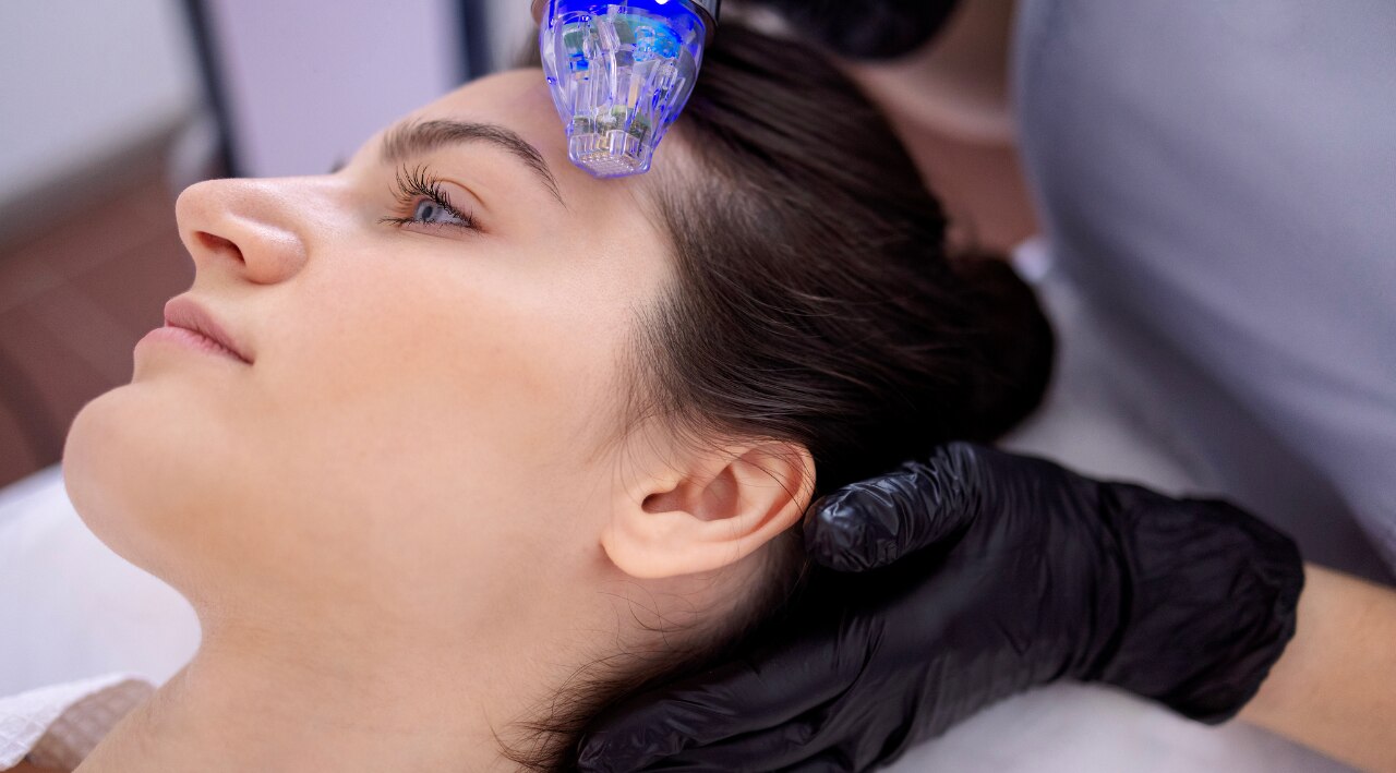 Microneedling for Pigmentation