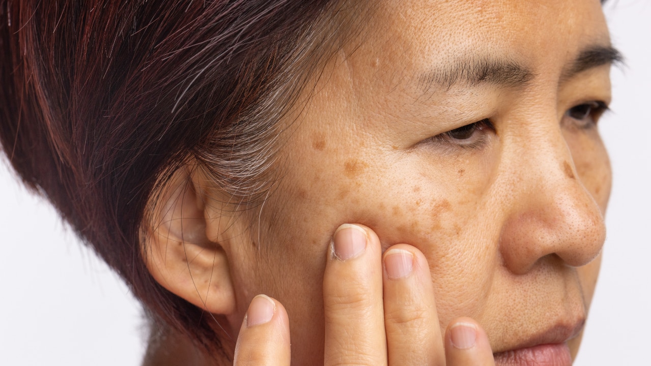 4. Minimises Pigmentation: