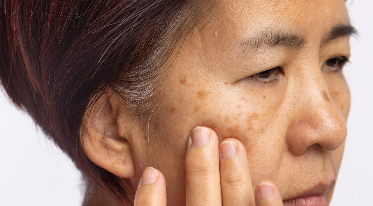 4. Minimises Pigmentation: