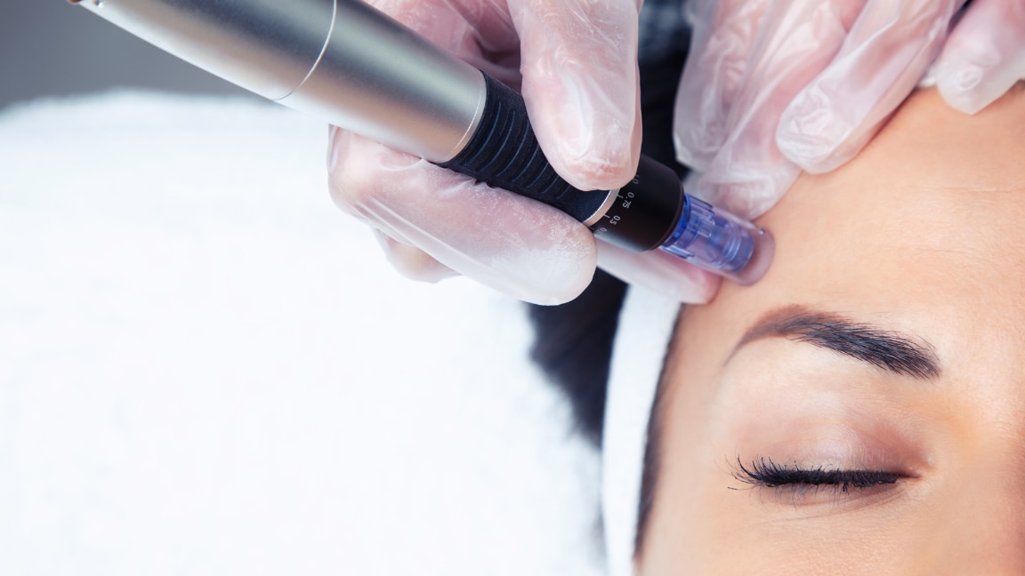 Image of Microneedling: Benefits for Skin, Side Effects, and Aftercare Tips
