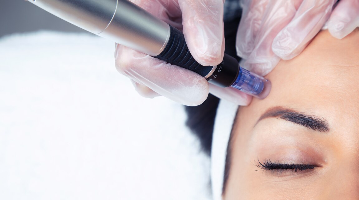 Microneedling benefits side effects and expert aftercare tips