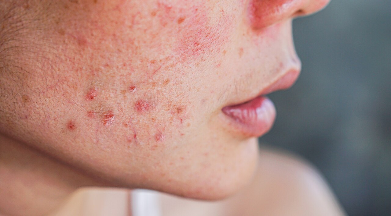 For Sensitive Skin: