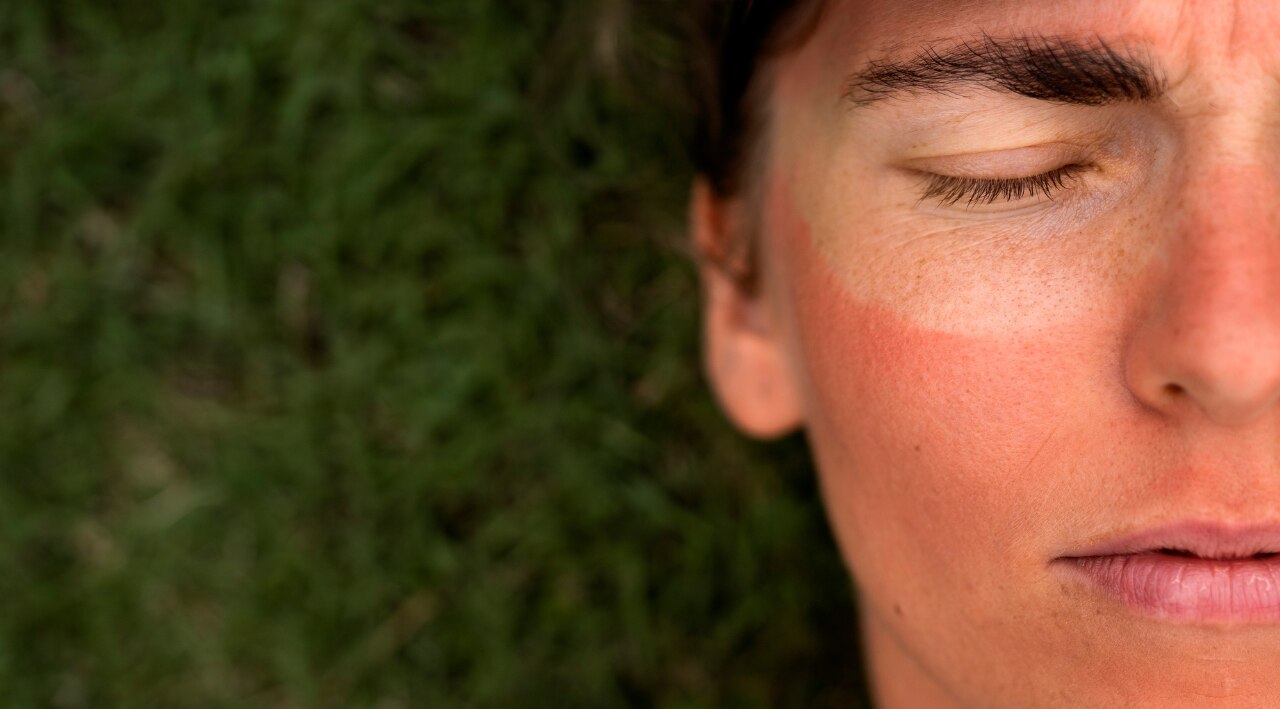 Winter sunburn is real:
