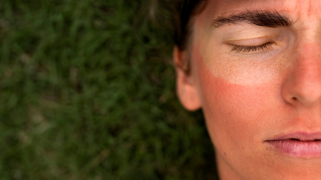 Winter sunburn is real: