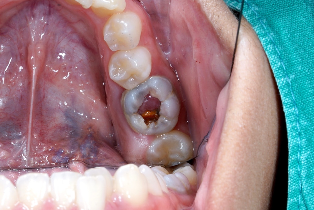 gusi gigi bungsu bengkak