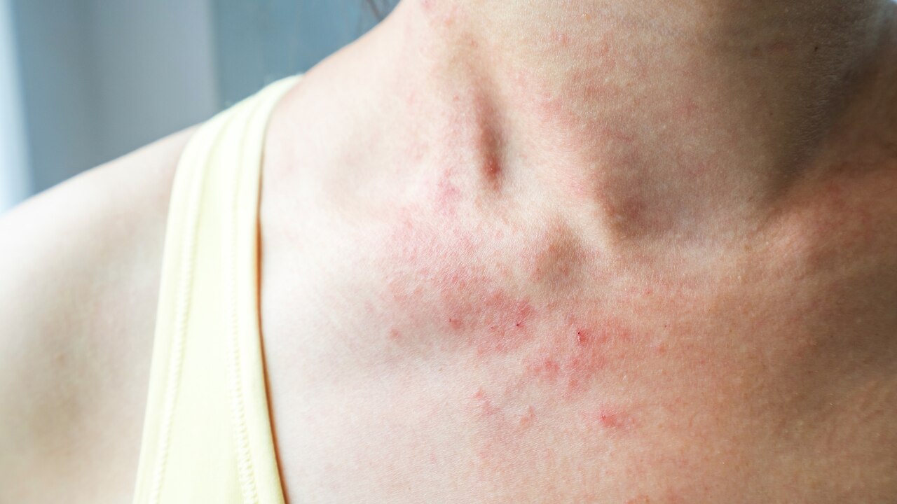 Physical Friction (Acne Mechanica):