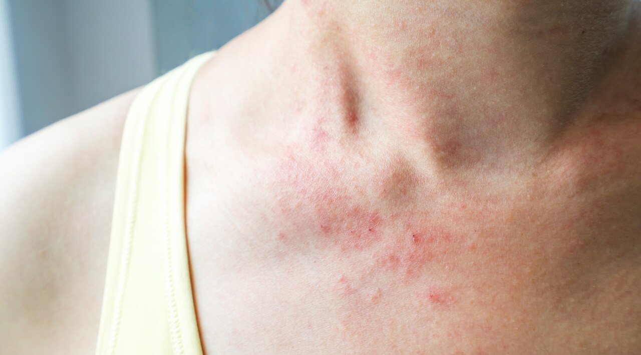 Physical Friction (Acne Mechanica):