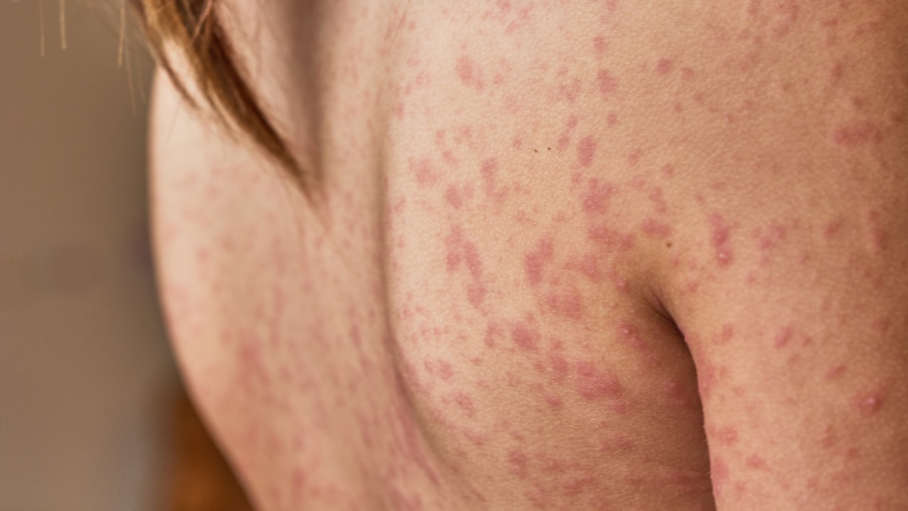 Body Acne Causes – Why It Happens