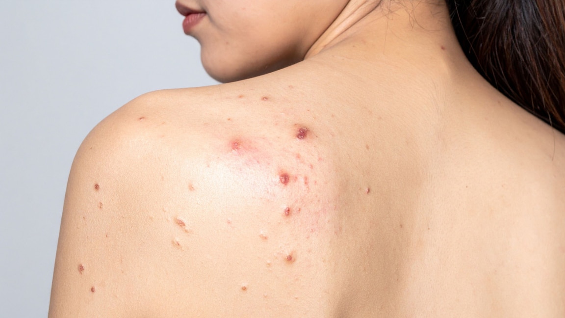 linking article: How To Get Rid of Body Acne, As Per Dermatologists