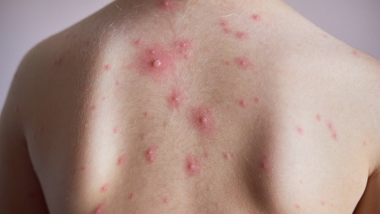 What Is Body Acne?