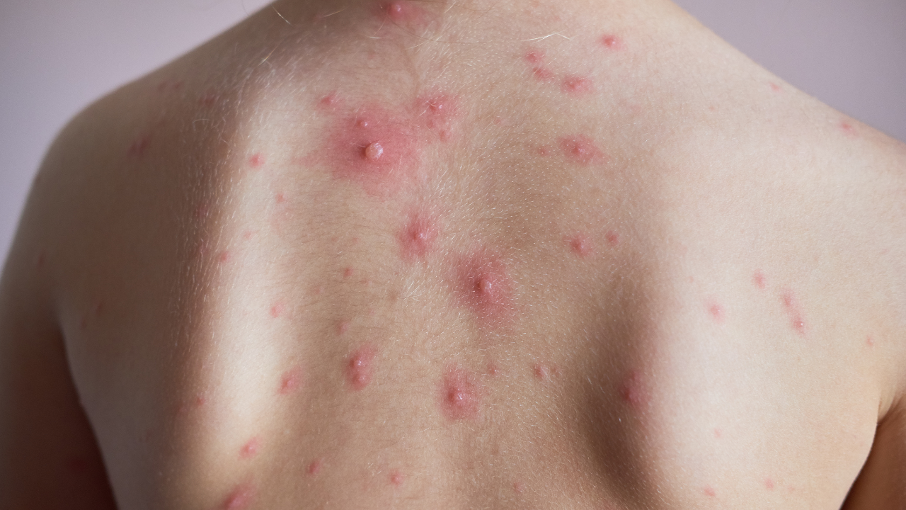 What Is Body Acne?