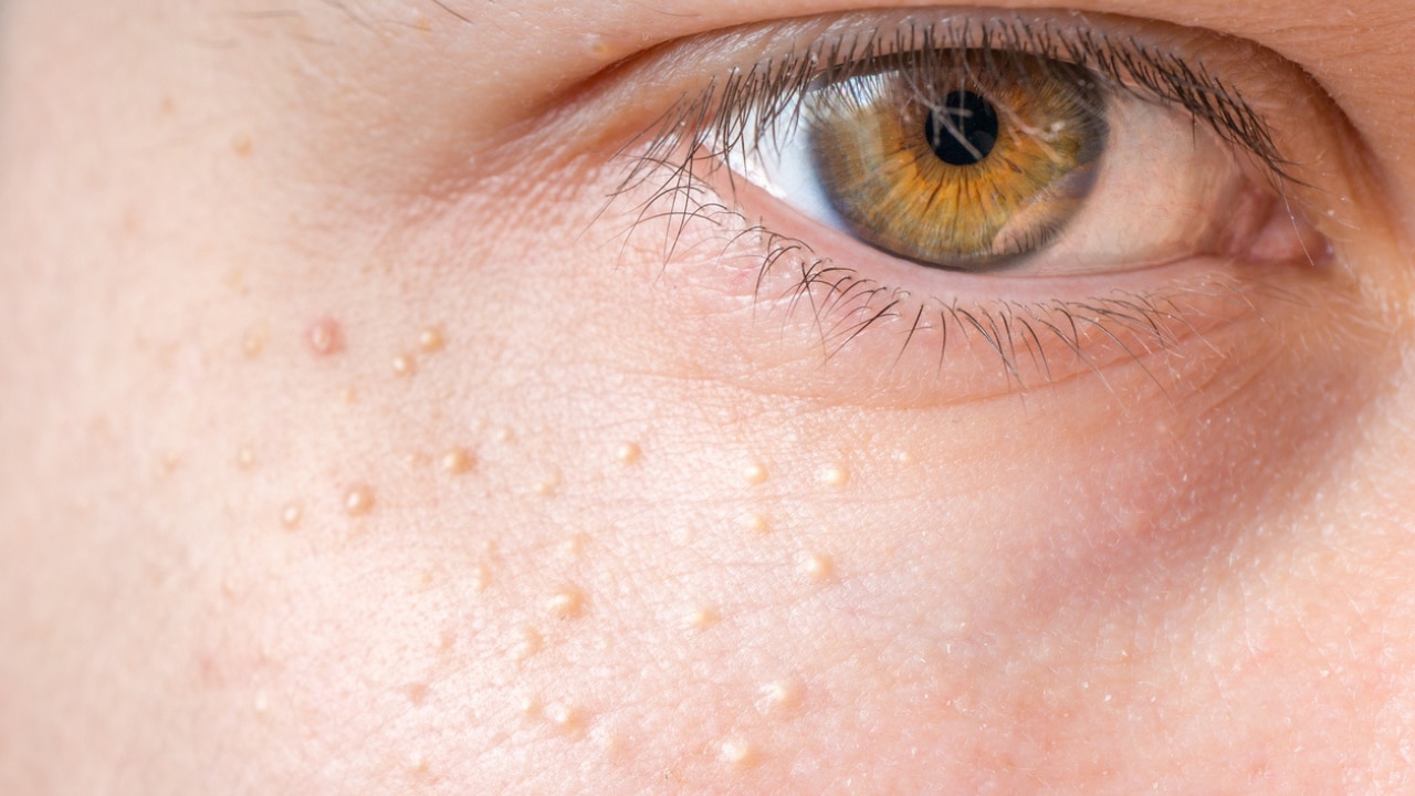 Types of Milia & Special Cases