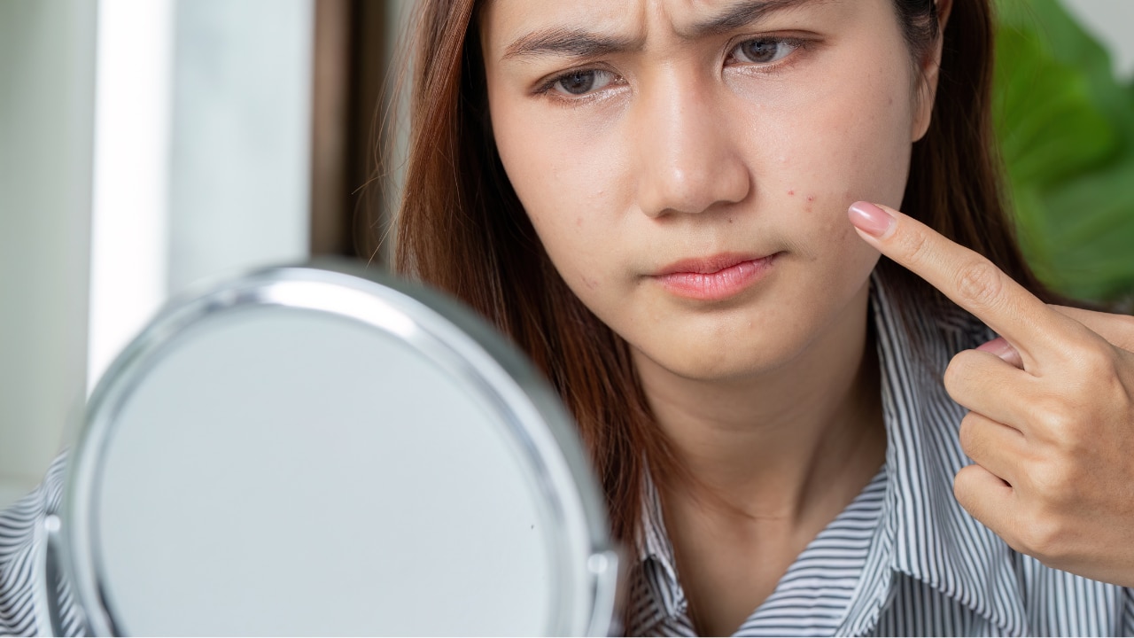 How to Identify Milia on the Face