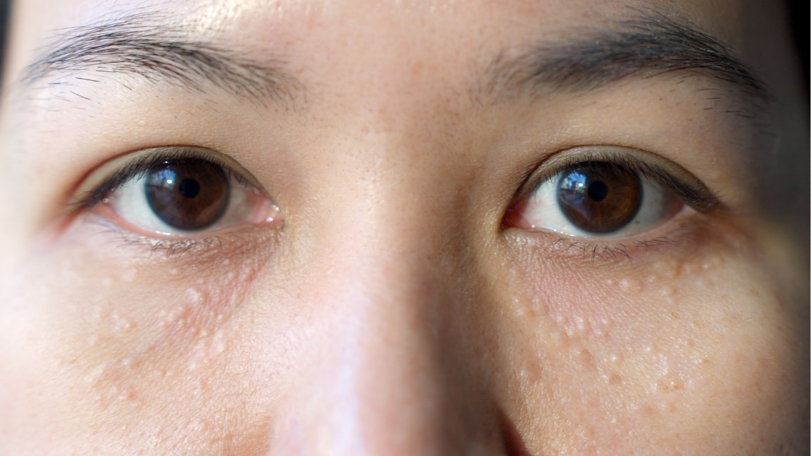 Image of How to Get Rid of Milia on Face: Causes, Treatments & Safe Home Remedies