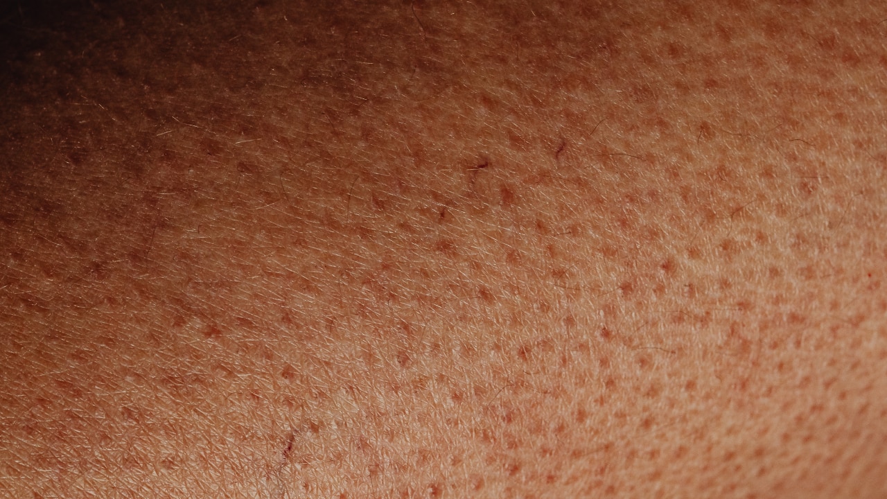 Blocked Pores/Keratin Retention: