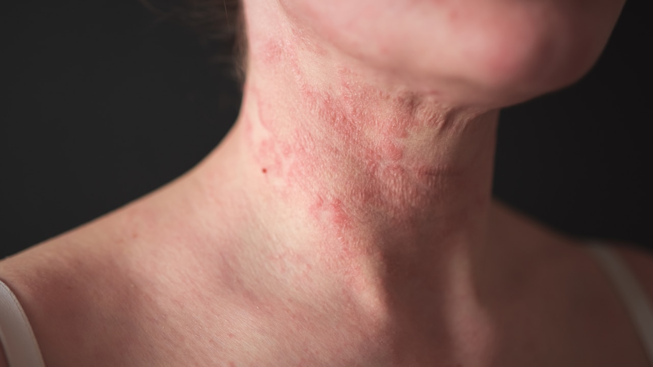 Inflammatory Skin Conditions: