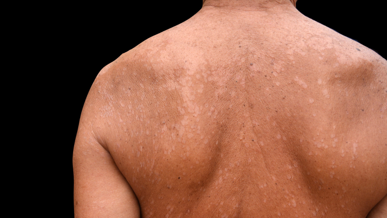 Pityriasis Versicolor (Tinea Versicolor):