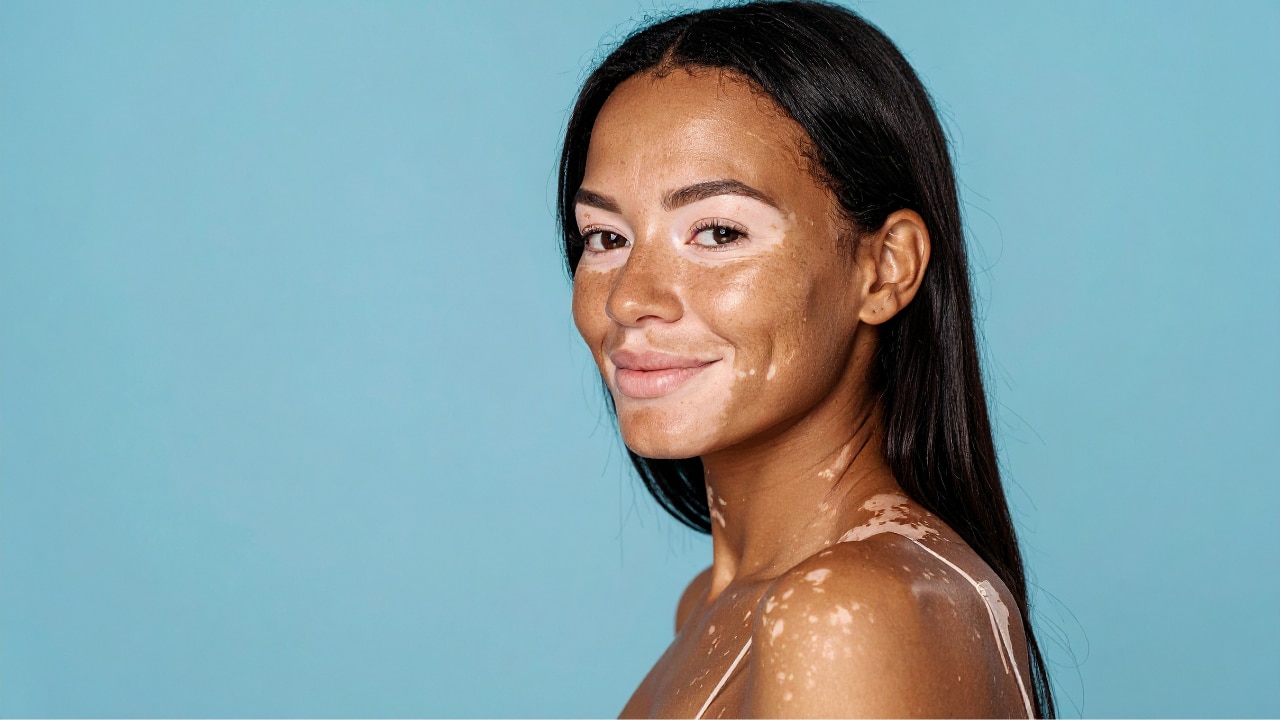 Vitiligo: