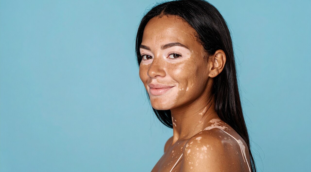 Vitiligo: