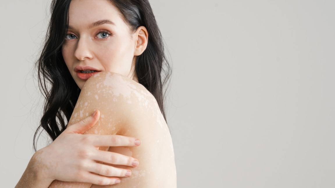 Image of White Spots on Face: Types, Causes and How to Treat them