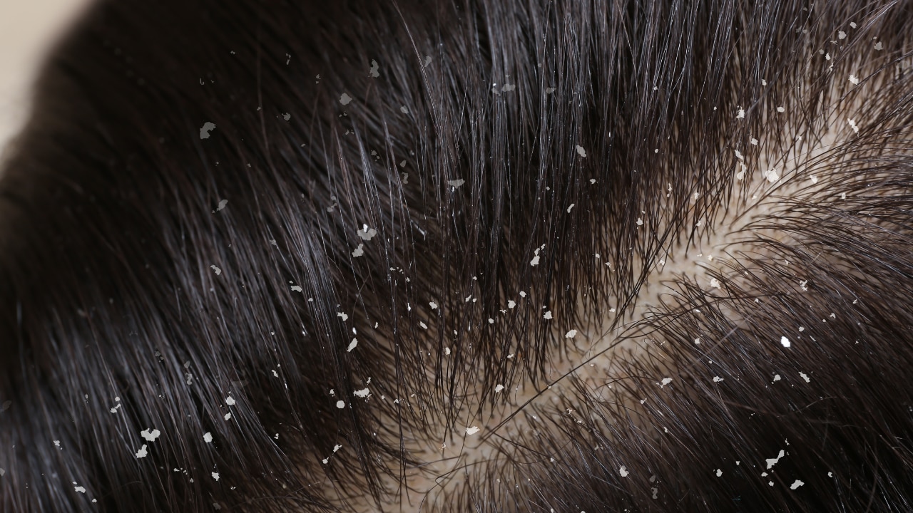 Fights Dandruff and Itching: