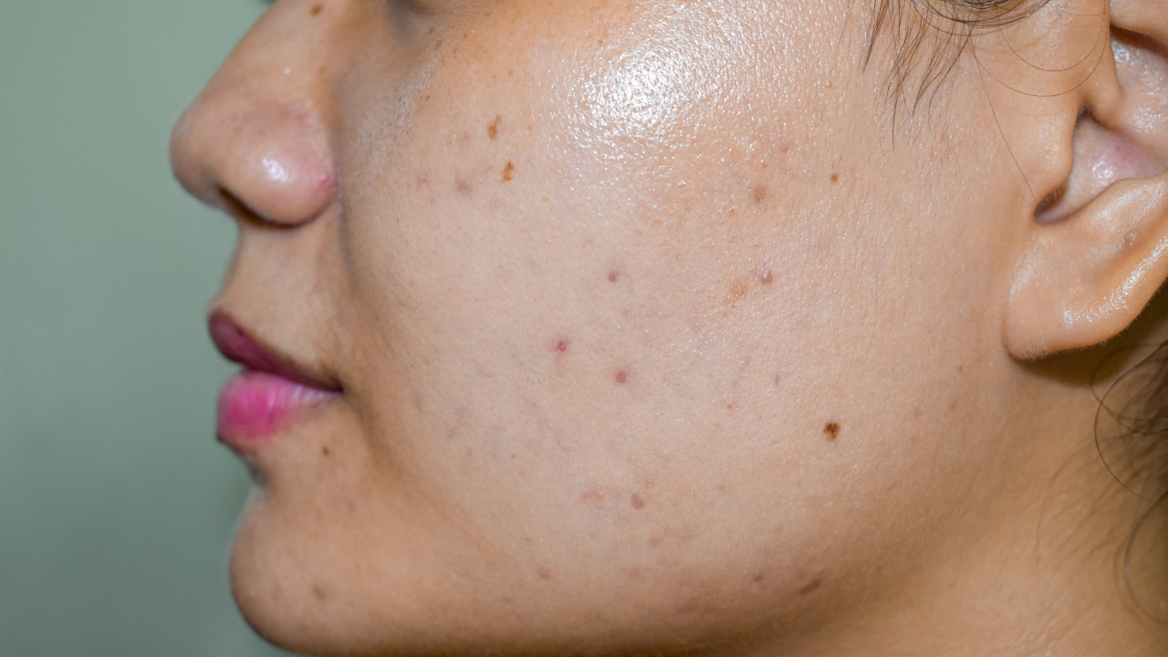 Reduces Dark Spots and Pigmentation: