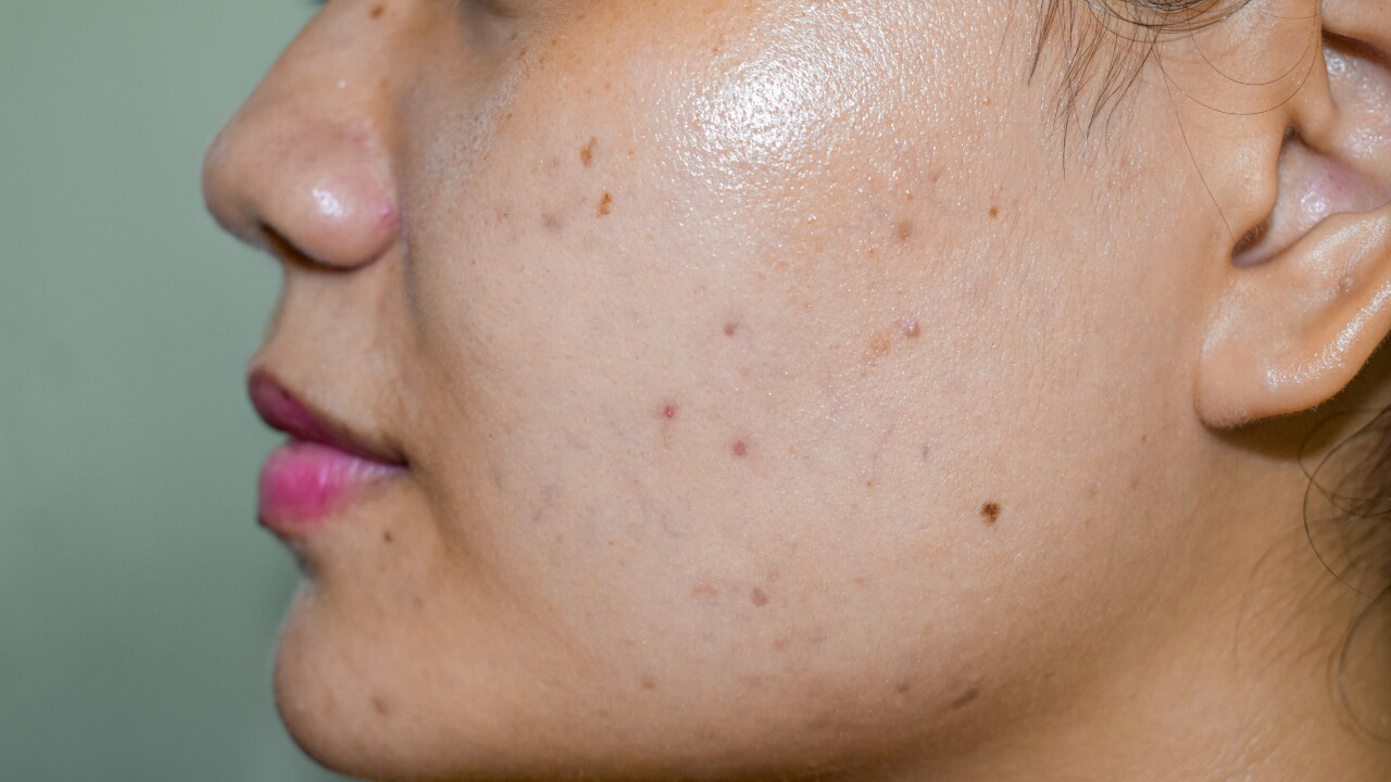 Reduces Dark Spots and Pigmentation: