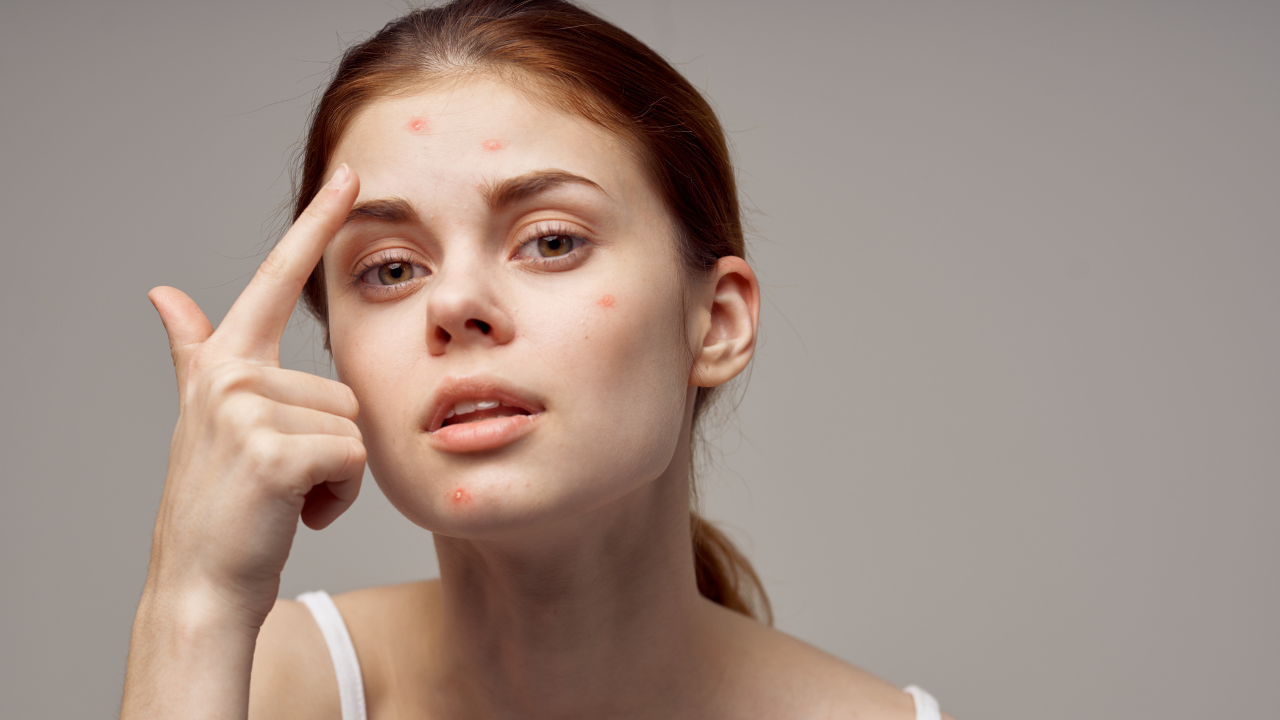 Acne Reduction: