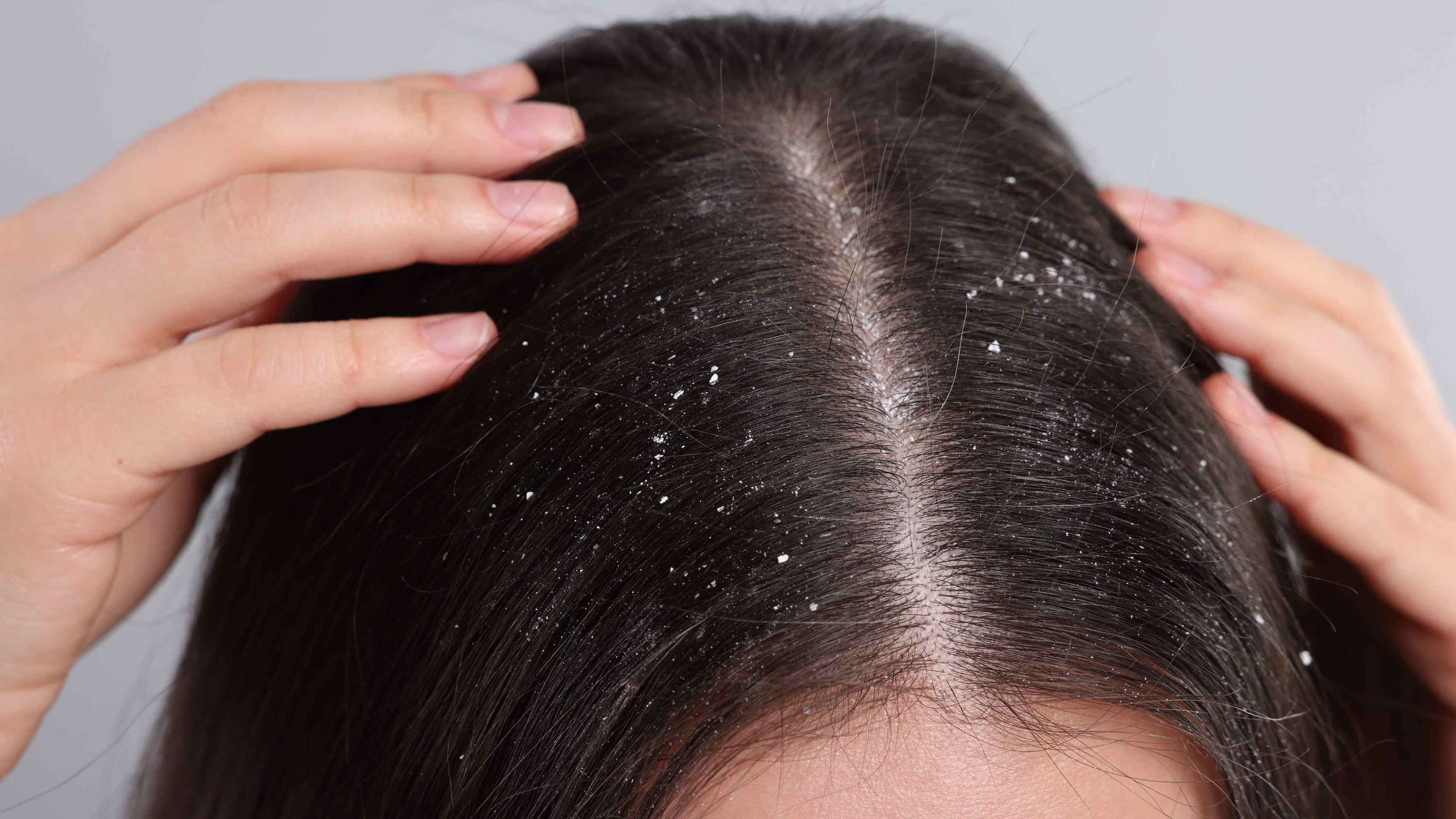 Combats Dandruff and Dryness: