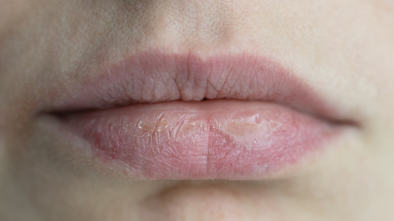 Prevents Cracking and Chapping: