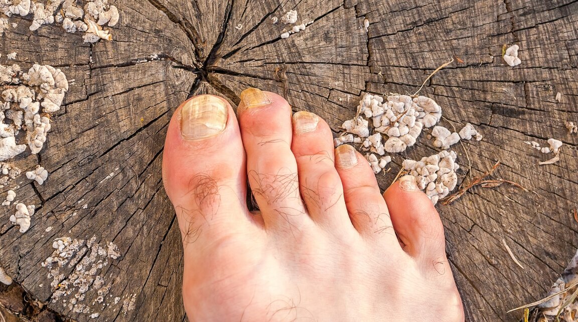 Home Remedies for Nail Fungus and Yellow Nails