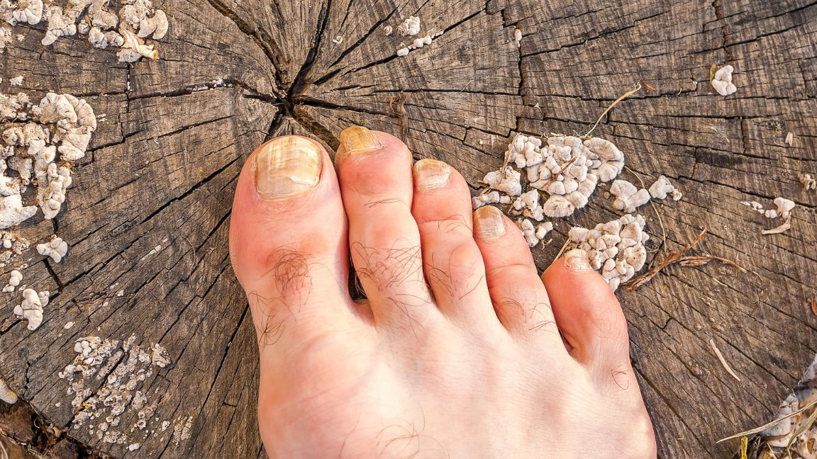 Home Remedies for Nail Fungus and Yellow Nails