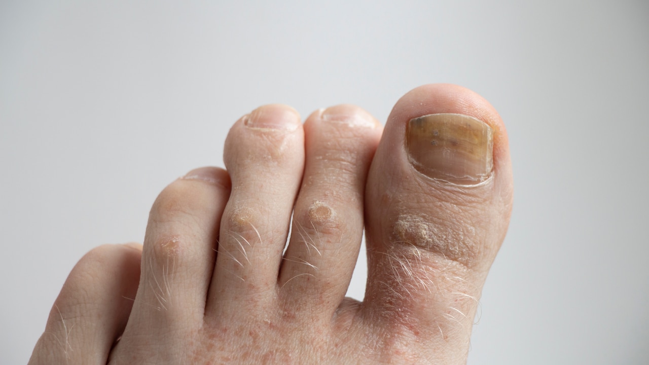 Common Signs of Nail Fungus: