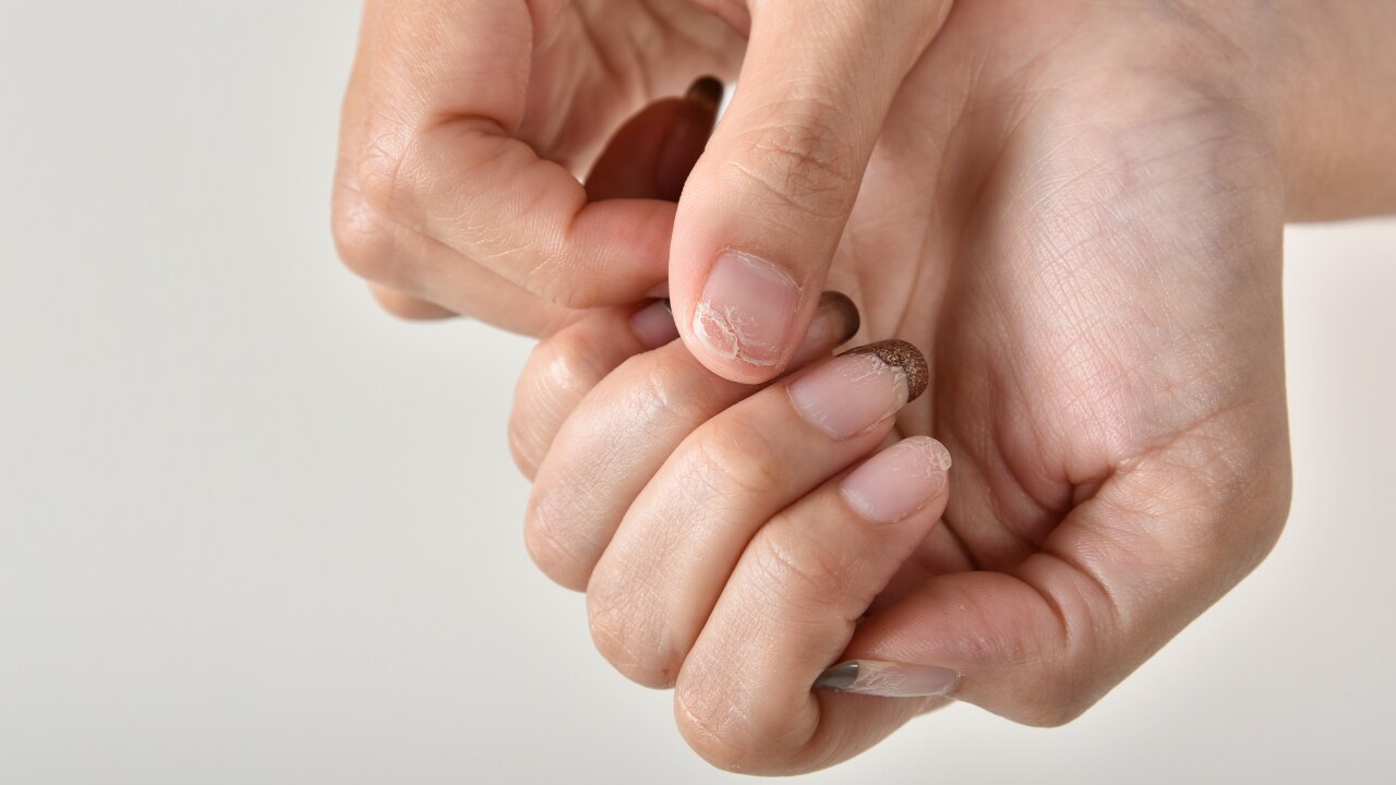 Minor Nail Trauma or Injury