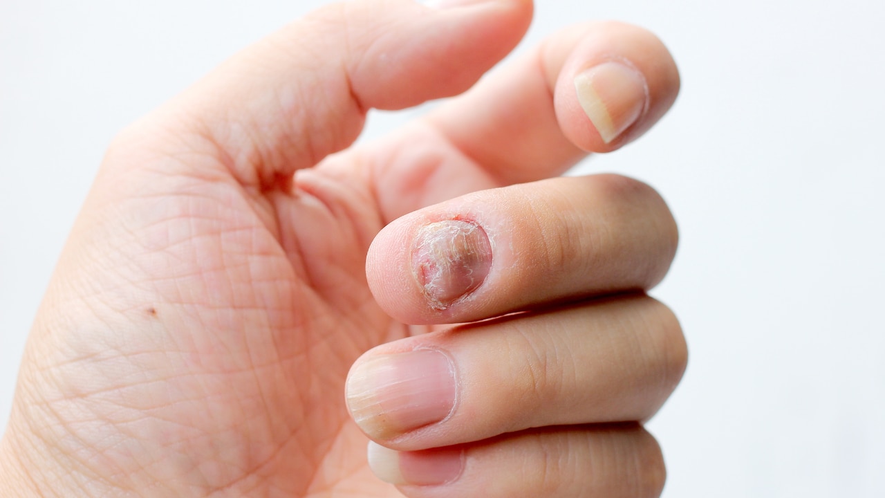 Understanding Nail Fungus