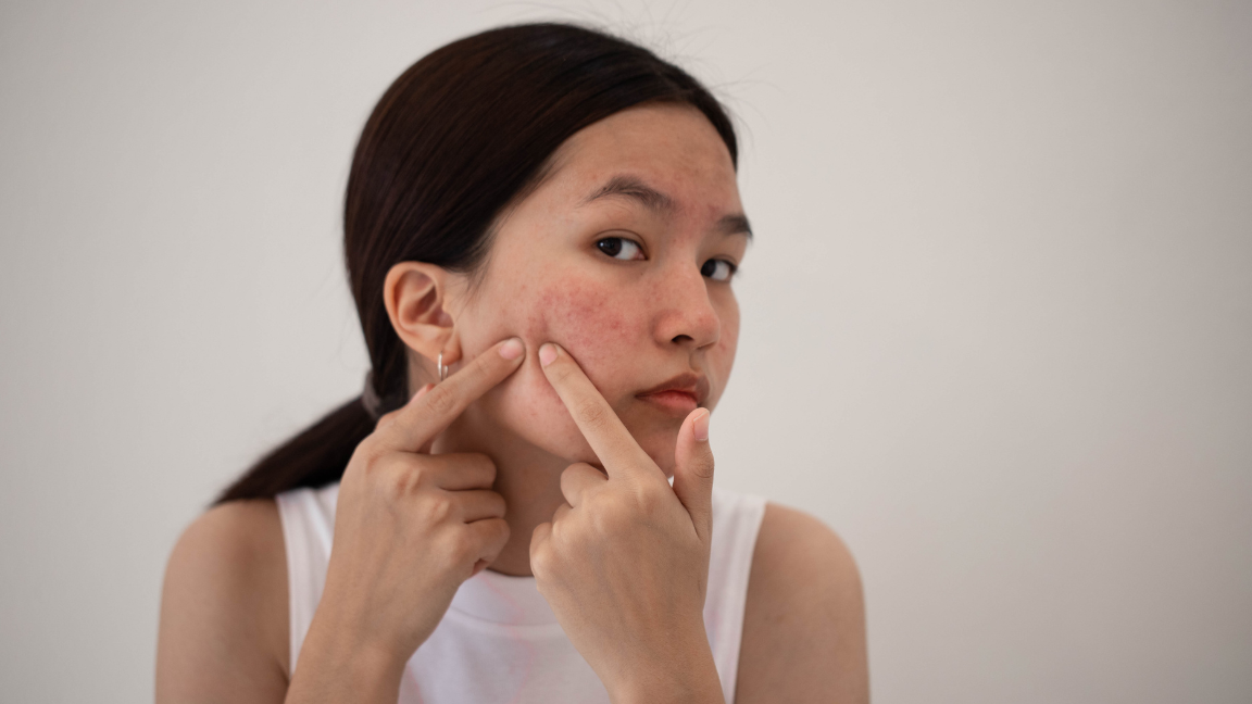 Face mapping guide to identify acne causes