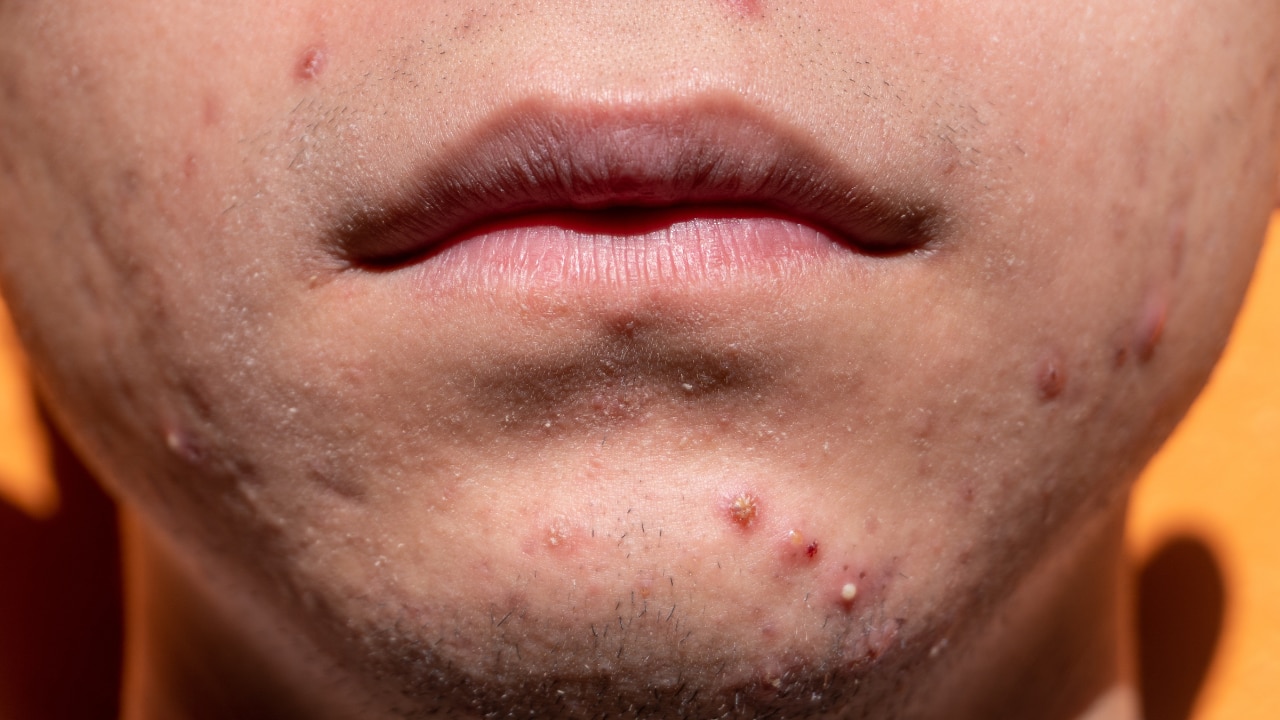 5. Chin & Jawline – Hormones & Digestive/Elimination Systems